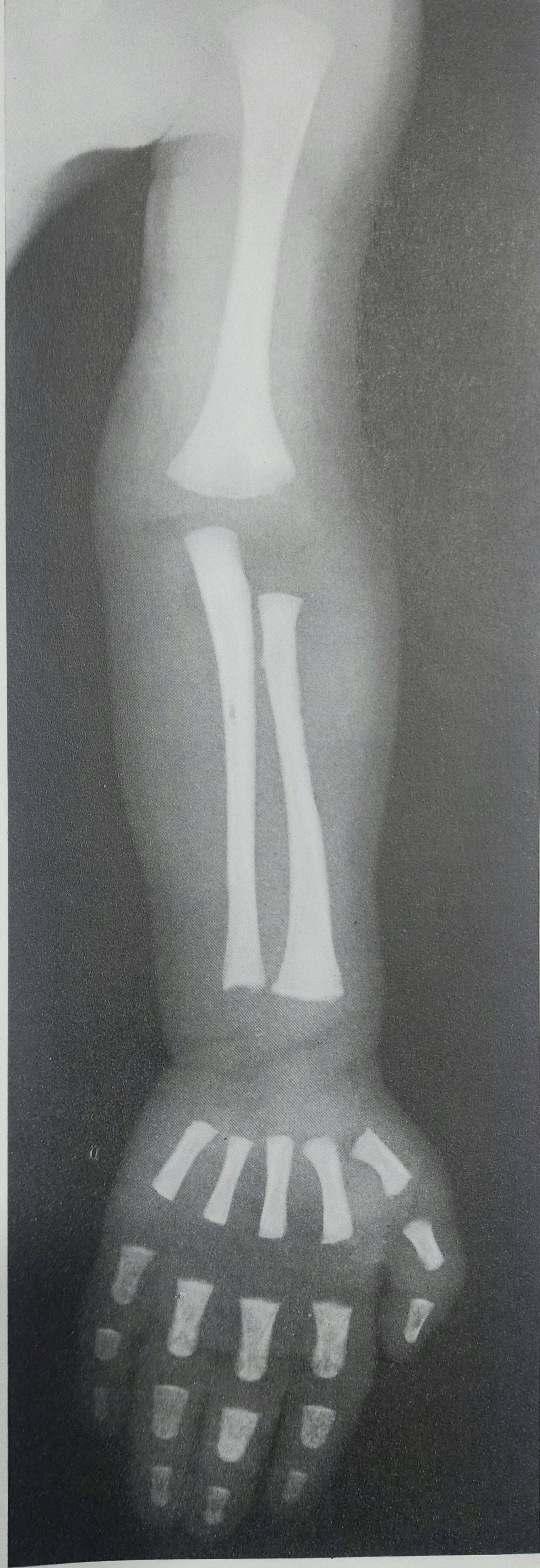 X ray of upper limb in Pediatrics.jpg