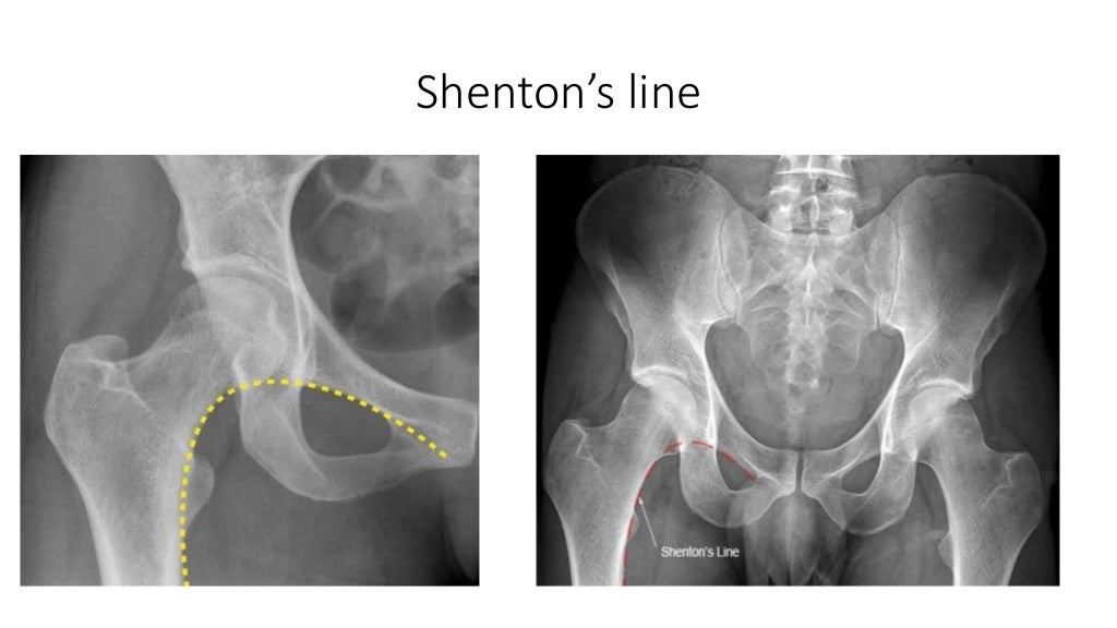 Shenton's line.jpg