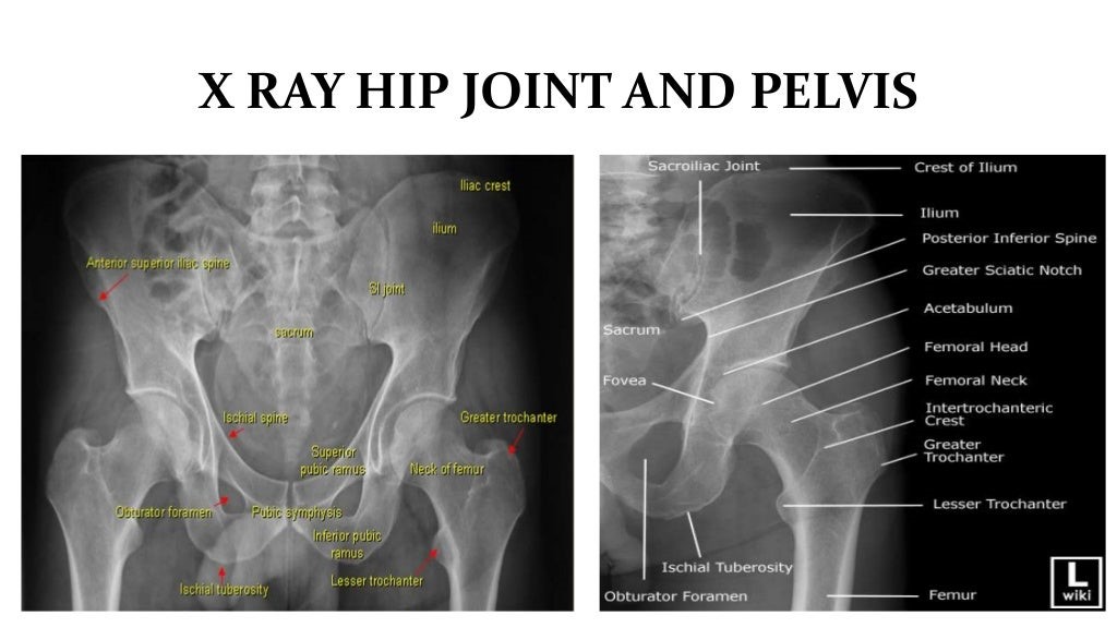 X RAY HIP JOINT AND PELVIS.jpg