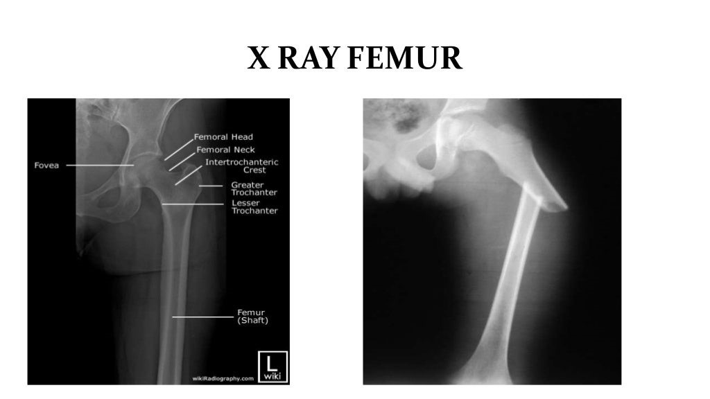 X RAY FEMUR.jpg