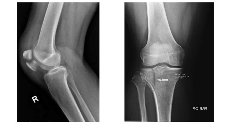 X RAY KNEE JOINT 1.jpg