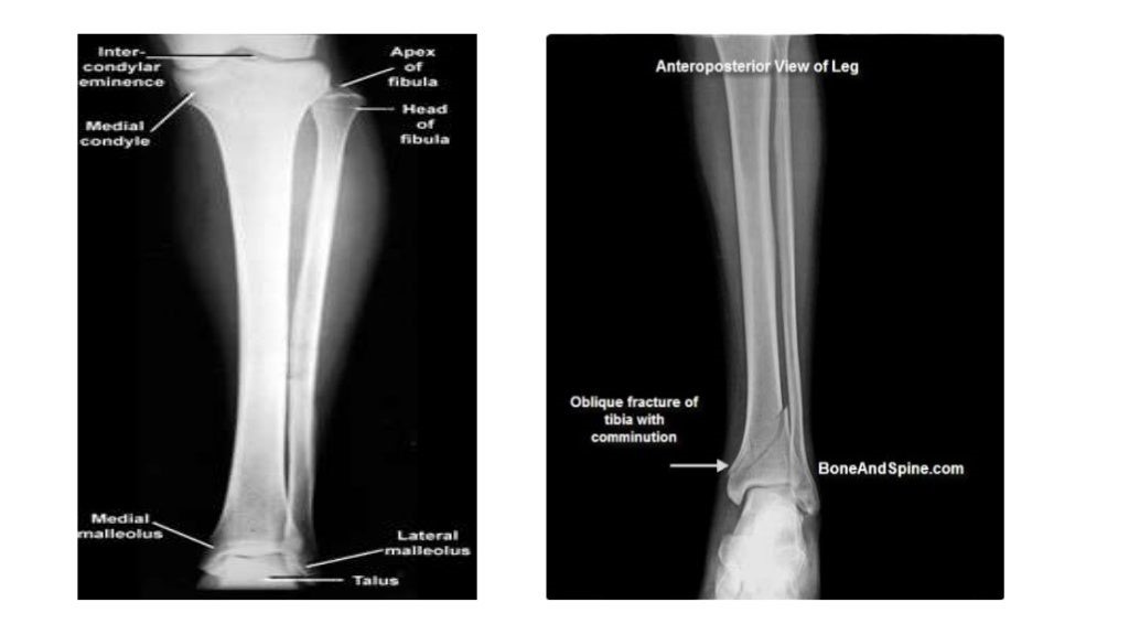 X RAY KNEE JOINT 2.jpg