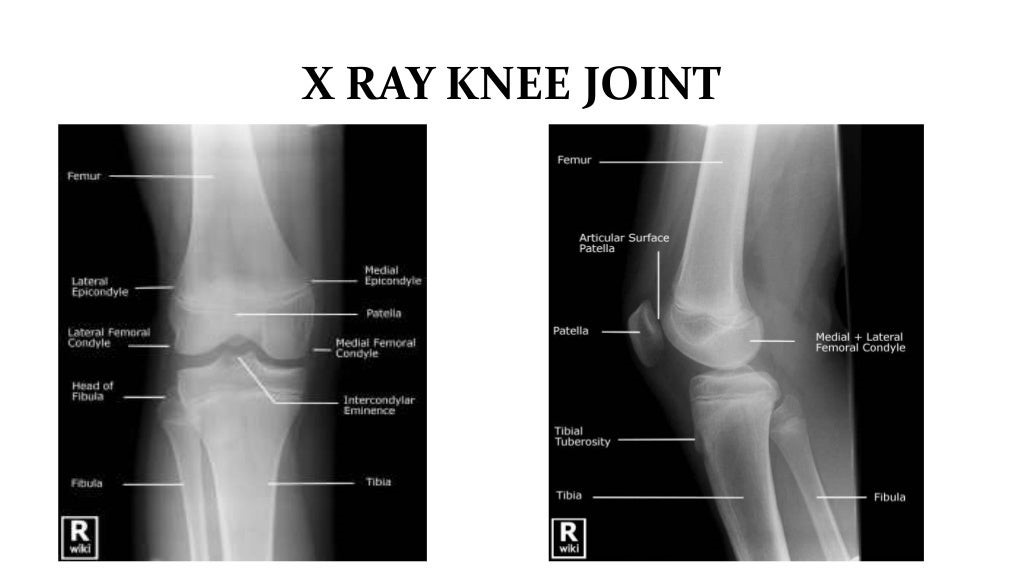 X RAY KNEE JOINT.jpg