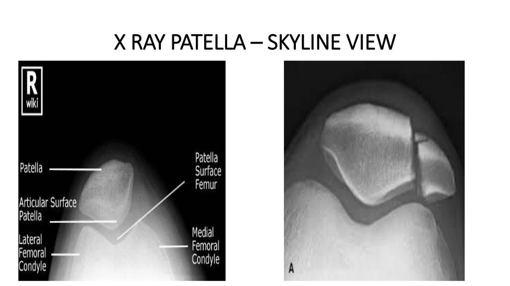 X RAY PATELLA - SKYLINE VIEW.jpg