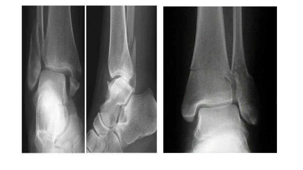 X RAY ANKLE JOINT 1.jpg