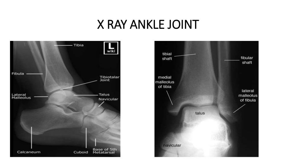 X RAY ANKLE JOINT.jpg