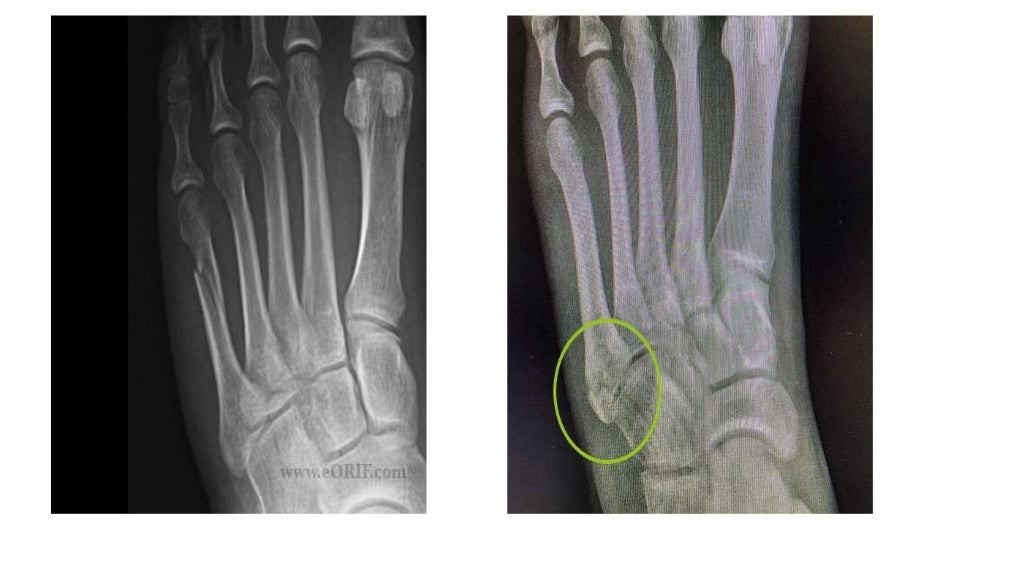 X RAY FOOT 1.jpg