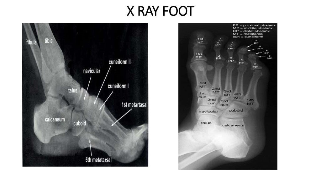 X RAY FOOT.jpg