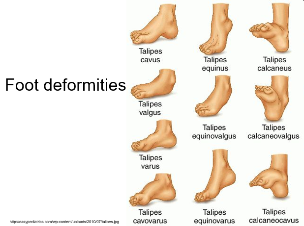 foot deformites.png