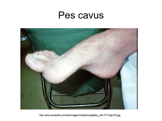 pea cavus.png