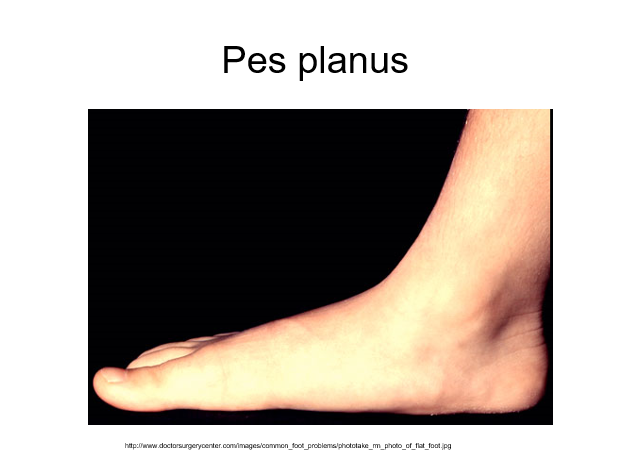 pes planus.png