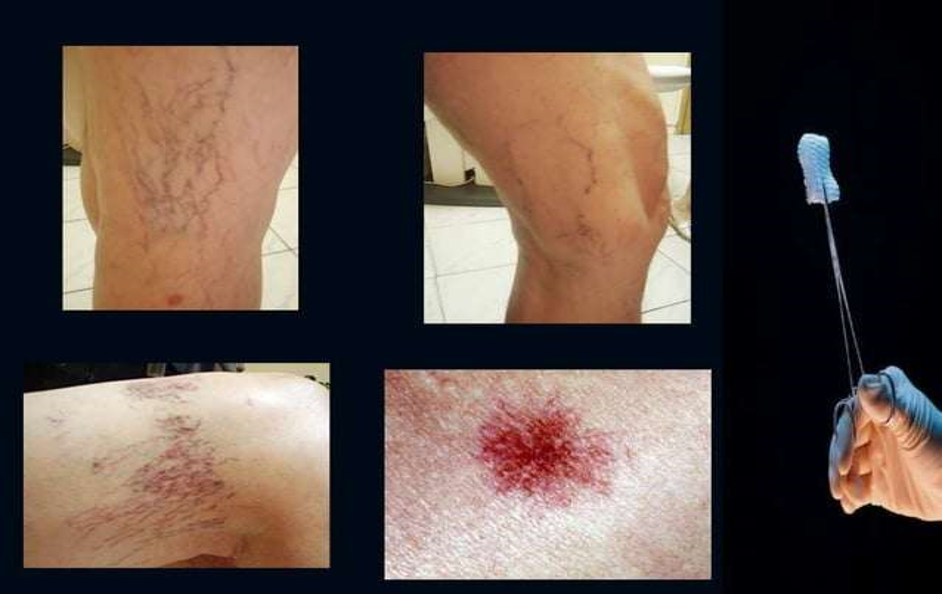 SPIDER VEINS.png
