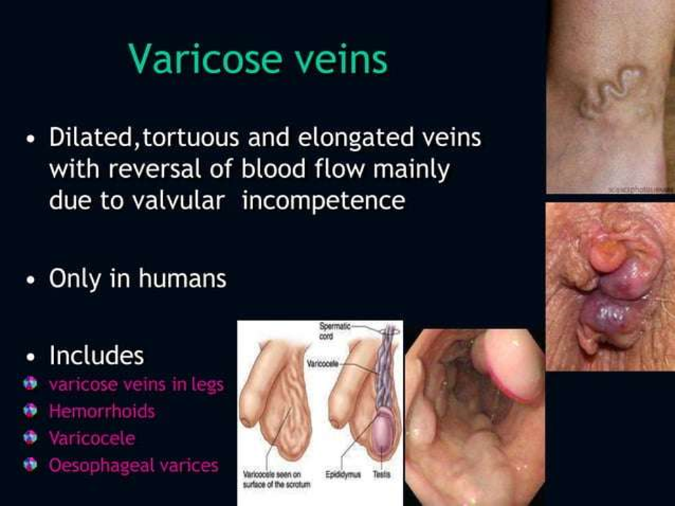 varicose veins.png