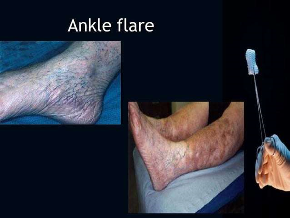 ankle flare.png