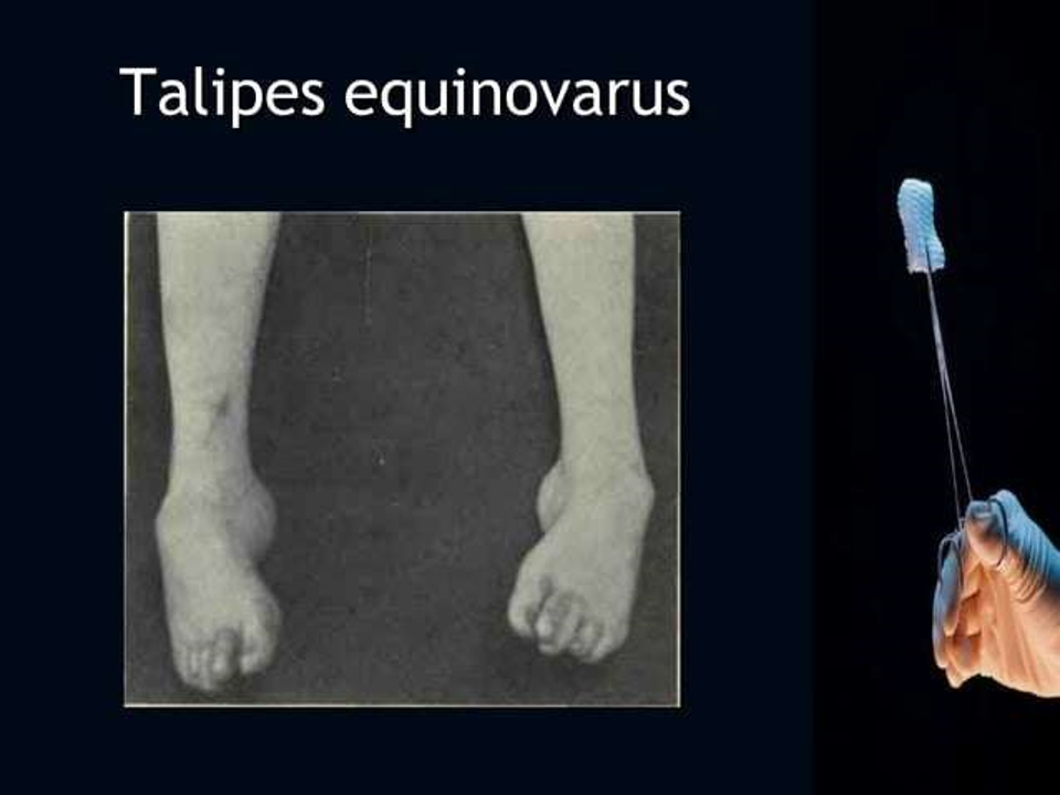 talipes equinovarus.png