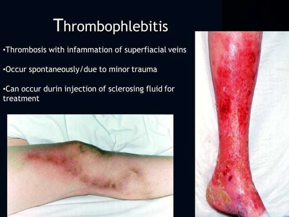thrombophlebitis.png
